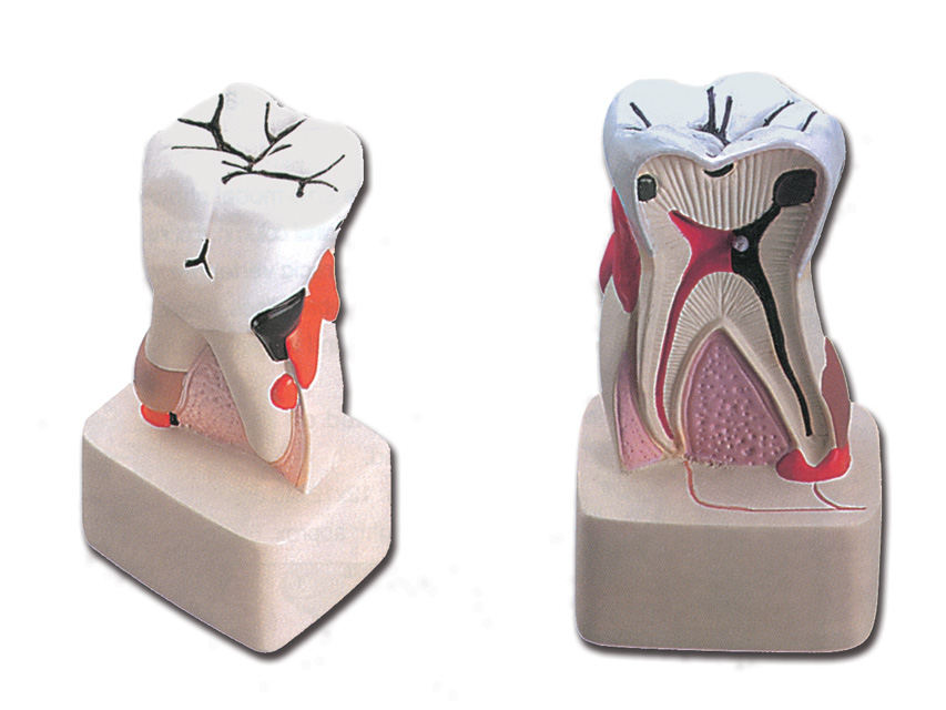 macheta didactica patologie dentara 4x