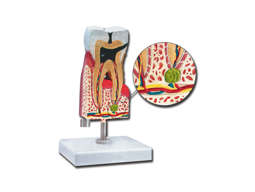 macheta didactica molar inferior cu carie 10x